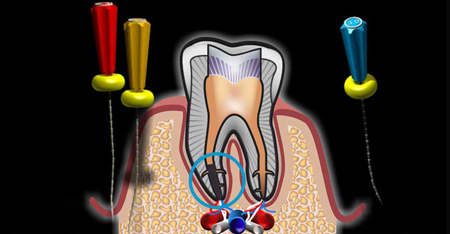 عصب کشی (روت کانال تراپی): درمان عفونت پالپ و ریشه دندان