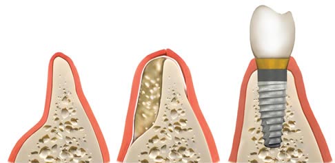 پیوند استخوان فک قبل ایمپلنت:افزایش تراکم استخوان برای کاشت دندان