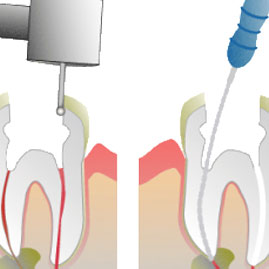 درد بعد از عصب کشی به علت عفونت دندان