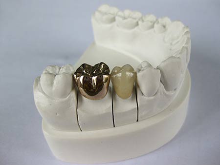 انواع روکش دندان (پرسلنی،سرامیکی) پوششی برای دندانهای آسیب دیده