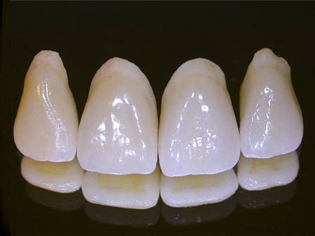 انواع روکش دندان (پرسلنی،سرامیکی) پوششی برای دندانهای آسیب دیده