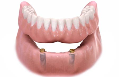دندان مصنوعی (کامل و تکه ای):پروتز ثابت و متحرک در افراد بی دندان