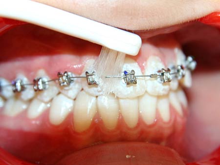 ارتودنسی ثابت برای درمان ناهنجاری و بی نظمی شدید دندان