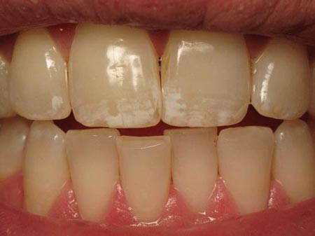 فلوروسیس:ایجاد لکه های سفید روی دندان ناشی از مصرف زیاد فلوراید