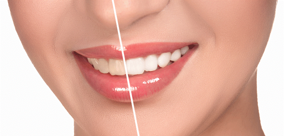 5 نکته که باید قبل از ونیر (لمینت ) دندان بدانید