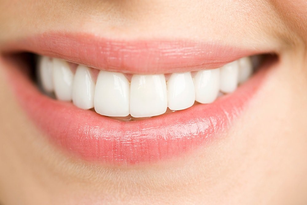 8 راه کار برای ماندگار کردن ونیر یا لمینت دندان