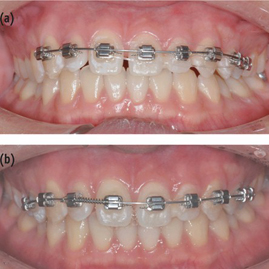 بستن فاصله یا گپ بین دندان (دیاستم) با ارتودنسی