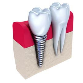 سوالات رایج ایمپلنت دندان و پاسخ به پرسش های متداول کاشت دندان
