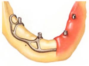 ایمپلنت دندان: جایگزین کردن دندان‌های طبیعی با کاشت دندان