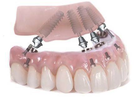 ایمپلنت دندان: جایگزین کردن دندان‌های طبیعی با کاشت دندان