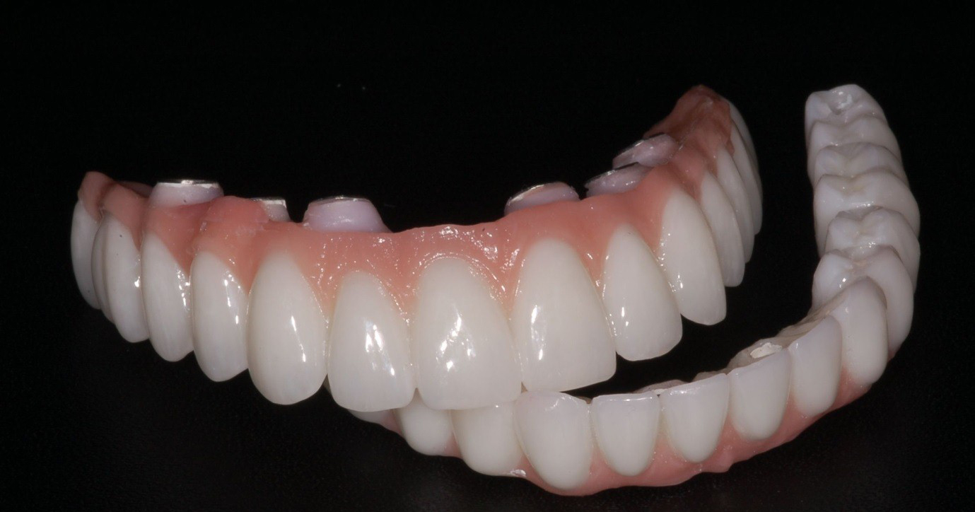 درمان بی دندانی کامل با کاشت ایمپلنت تمام فک بر پایه 4 ایمپلنت (all on 4)