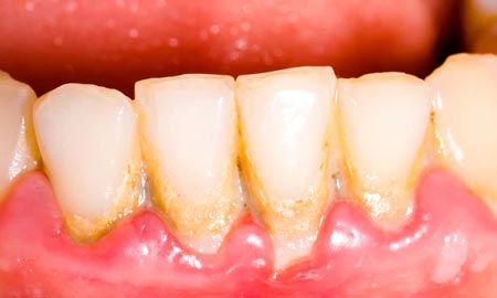 درمان پلاک و جرم دندان:تخریب مینا دندان با باکتری‌های بیماری‌زا