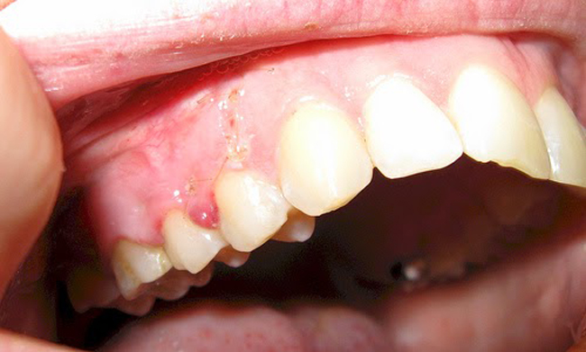 درمان کیست دندان و لثه:خارج کردن عفونت با روش غیرتهاجمی و جراحی