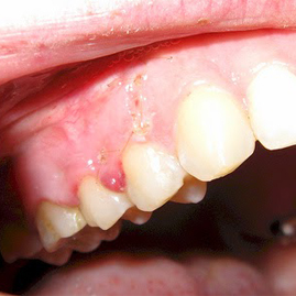 درمان کیست دندان و لثه:خارج کردن عفونت با روش غیرتهاجمی و جراحی