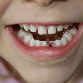 کشیدن و ترمیم بدون درد دندان شیری و دائمی لق و پوسیده در کودکان
