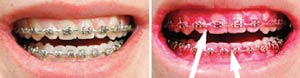 آموزش مسواک زدن و نخ دندان کشیدن در ارتودنسی برای سلامتی دندان