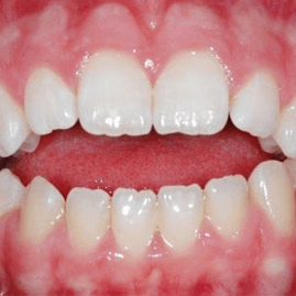 اپن بایت (فاصله بین دندان بالا و پایین):درمان مشکلات گفتار و زیبایی