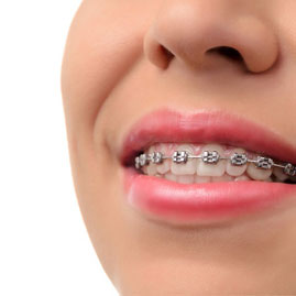 ارتودنسی با براکت یا بریس فلزی بهترین روش در مرتب کردن دندانها
