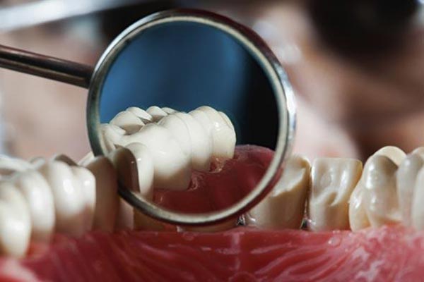 پوسیدگی و خرابی دندان: نقش کاهش اسیدیته دهان در کرم خوردگی دندان