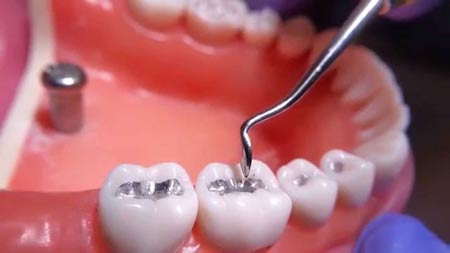 پر کردن دندان بهترین روش ترمیم بخش آسیب دیده دندان