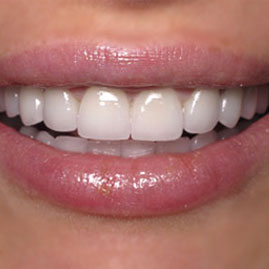 پرسلاین ونیر دندان با چه رنگ و شکلی برای من مناسب است؟