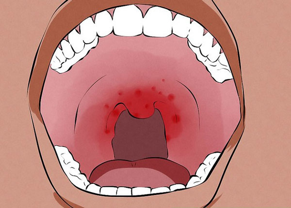 4 راه درمان سرطان دهان (زبان، لثه، گلو و حنجره) در کودکان و بزرگسالان