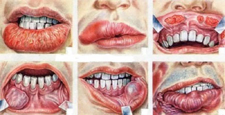 4 راه درمان سرطان دهان (زبان، لثه، گلو و حنجره) در کودکان و بزرگسالان
