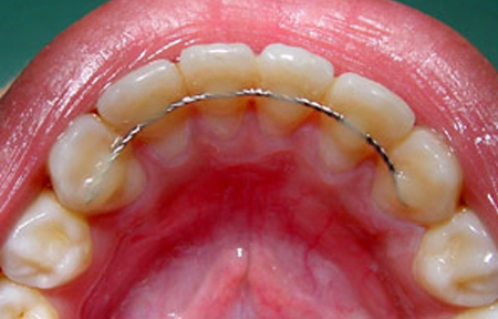 نگه دارنده (پلاک،ریتینر):پیشگیری از نامرتبی دندان بعد از ارتودنسی