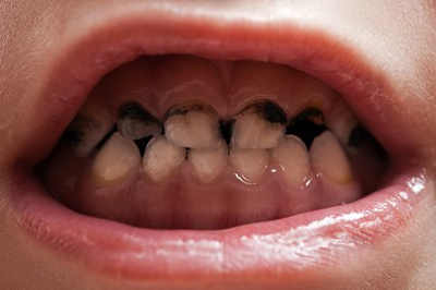 علت و درمان لکه های سیاه داخلی و خارجی مینای دندان کودکان