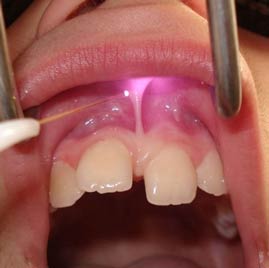 فرنکتومی با لیزر (جراحی برداشت بند زیر زبان و لب) بدون خونریزی