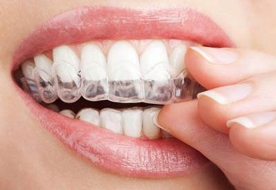درمان کراس بایت و پیشگیری از انحراف قوس دندانی و اختلال جویدن